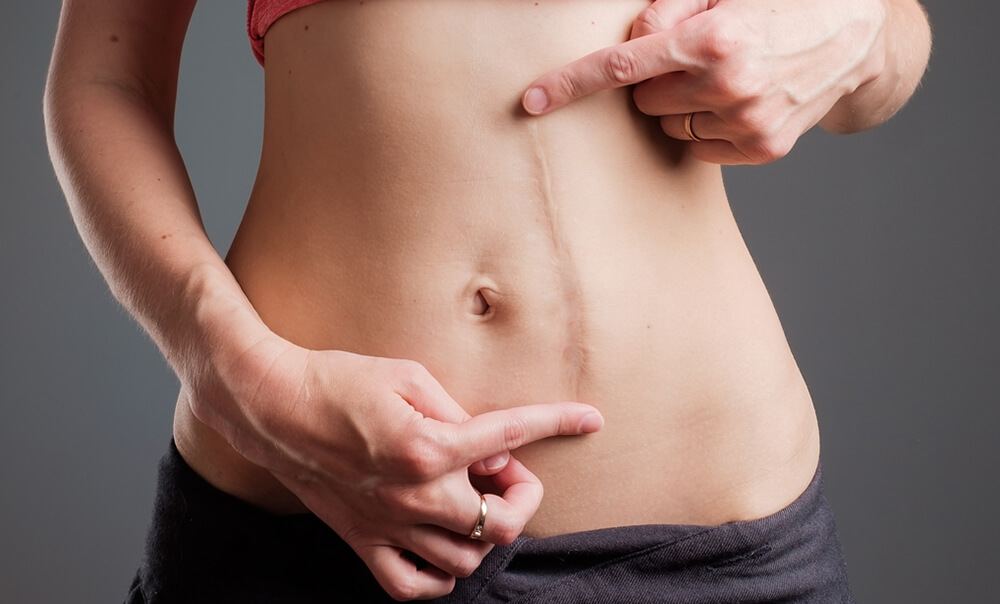 tratamente cicatrici