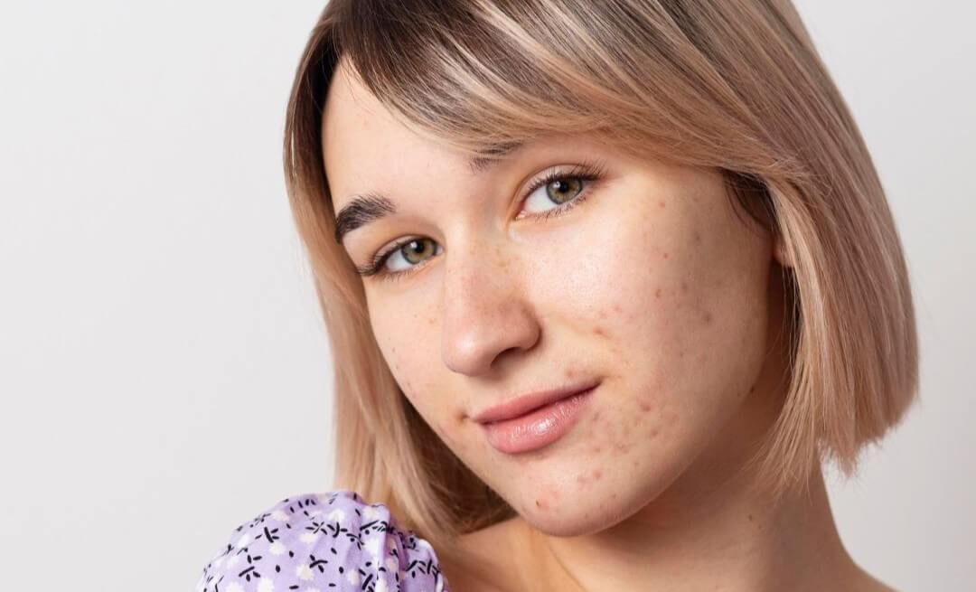 cicatrici post-acneice: apar atunci când pielea nu se reface complet uniform după inflamație.
